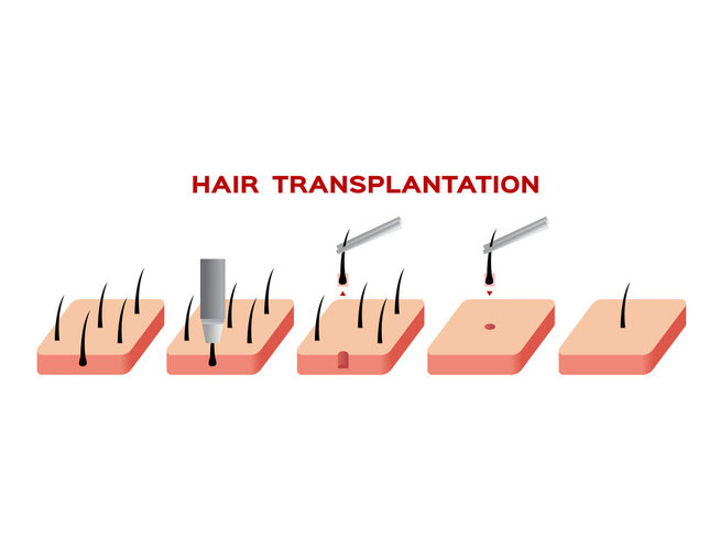 Is Hair transplant going to cost you a Bomb? Not Really!