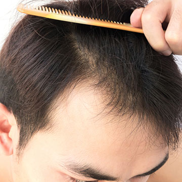 9 SIGNS TO IDENTIFY IF IT'S LIKELY FOR YOU TO GO BALD