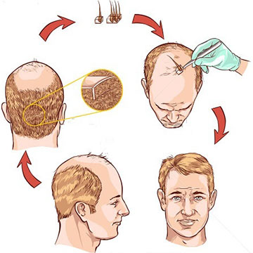 IS HAIR TRANSPLANT A PERMANENT Solution?
