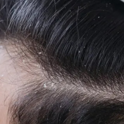 How to Get Rid of Dandruff? 10 Easy Tips for It