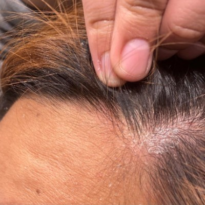 Scalp Infection: Causes, Signs, and Treatment