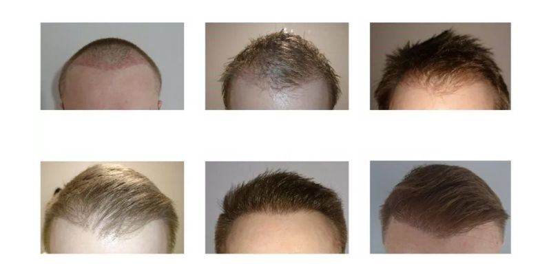 The Ultimate Roadmap for a Successful Hair Transplant