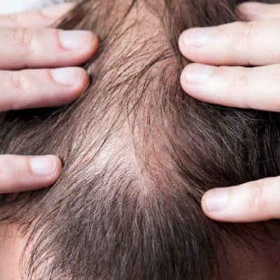 What Is a Hair Patch & How Long Can It Last?